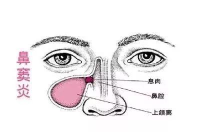 成人鼻窦炎培养视频播放